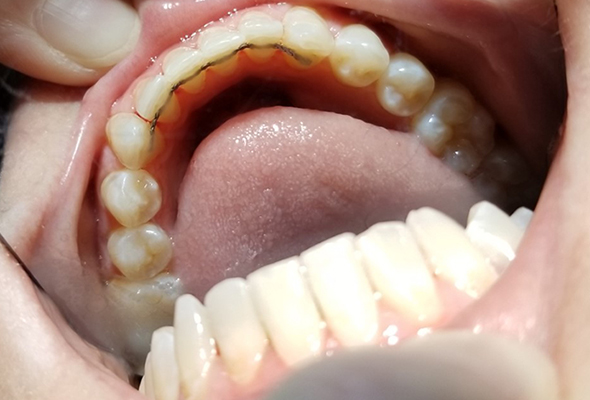 Mouth/teeth after Inman Aligners