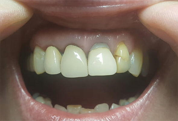 Mouth/teeth before dental treatment