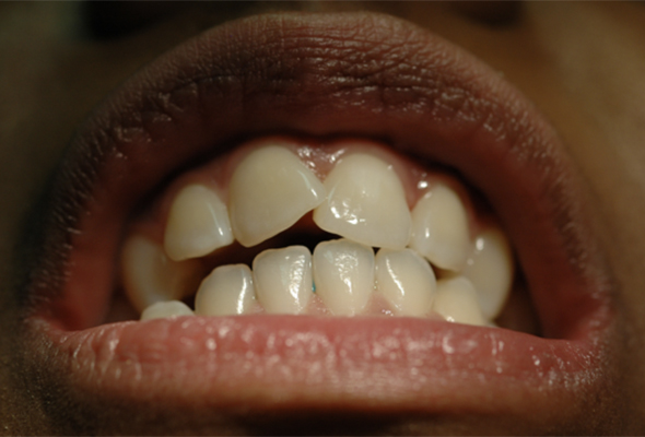 Mouth/teeth before dental treatment